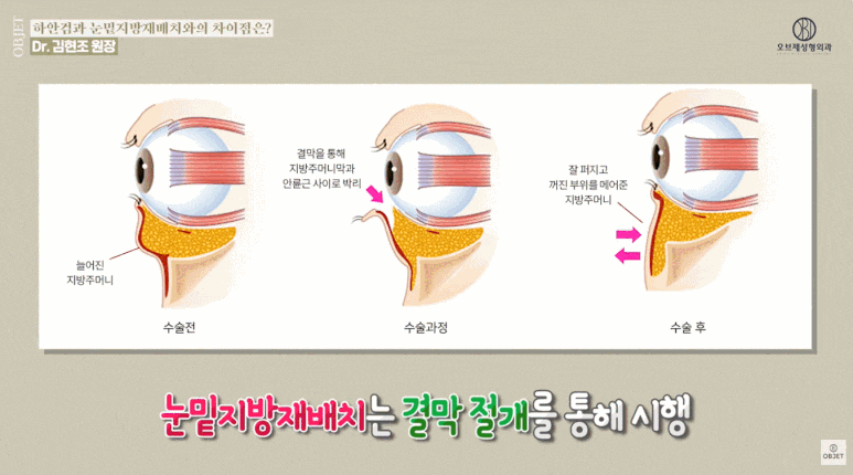 눈밑지방재배치 전후 흉터? 김현조 원장님의 <고민 타파> 관련 이미지 3