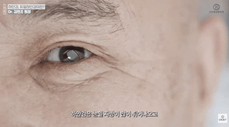 눈밑지 성형외과 유지 기간 평생 갈까? 김현조 원장님 정리 관련 이미지 13