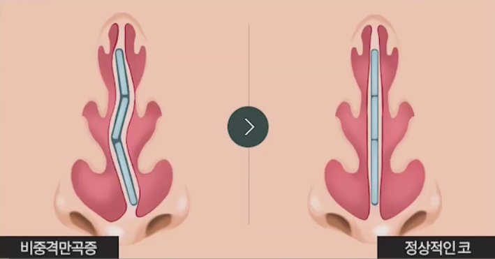 Nasal Surgery for Rhinitis: You Should Choose a Clinic That Knows ‘This’ Well! image 9