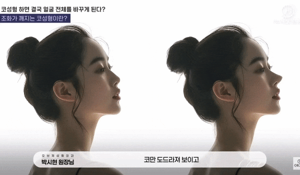 The Key to a Successful Celebrity Rhinoplasty Consultation Lies Not in the Nose, but in ○○? image 10