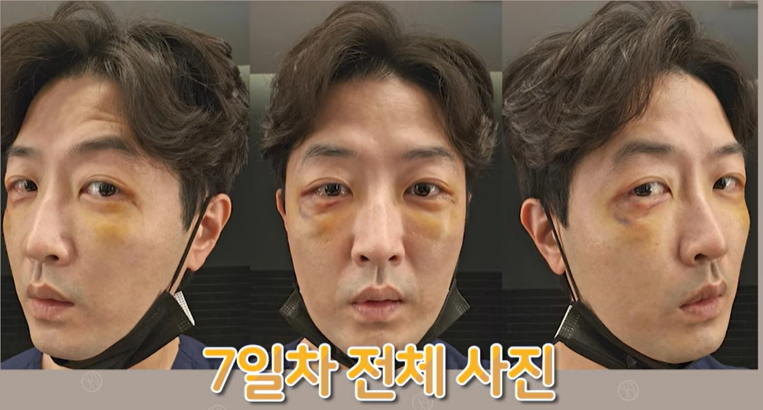 듀얼하안검 후기, 수술당일부터 69일까지 생생보고 #오브제성형외과 장욱원장님 관련 이미지 15