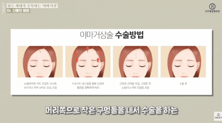 Karina Forehead Lift Cost? Dr. Shin Jong-in’s <Q&A> image 8