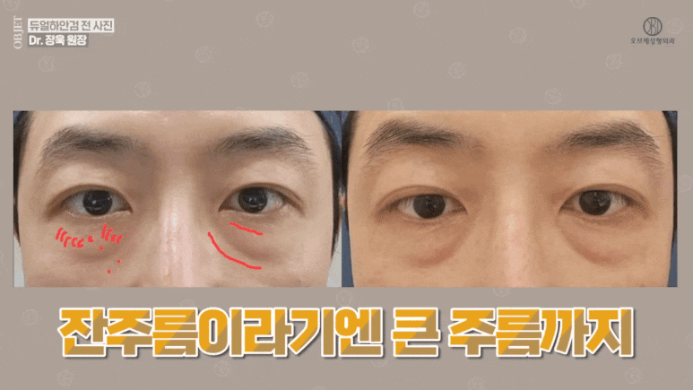 듀얼하안검 후기 매일 수술하던 의사가 직접 들려드립니다! 관련 이미지 9