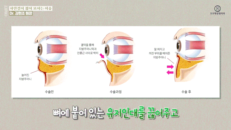 50대 하안검수술후기, 동안 효과는 여기서 갈린다고요? 관련 이미지 12