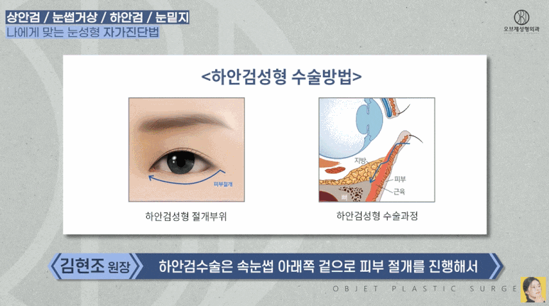What Is the Difference Between Upper Eyelid and Lower Eyelid Surgery? Are There Different Procedures for Different Eyes? (Explanation by a Board-Certified Plastic Surgeon) image 16