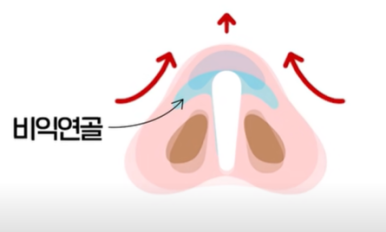 코성형 콧구멍 110V 빨래집게 코 #이경묵원장님 관련 이미지 5
