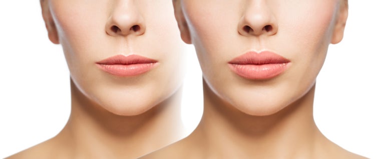 When Revision Rhinoplasty Is Needed #Gangnam Plastic Surgery #Obje image 6