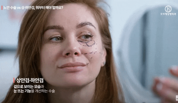 Upper and Lower Eyelid Surgery vs. Presbyopia Surgery: Which Should You Have First? image 5