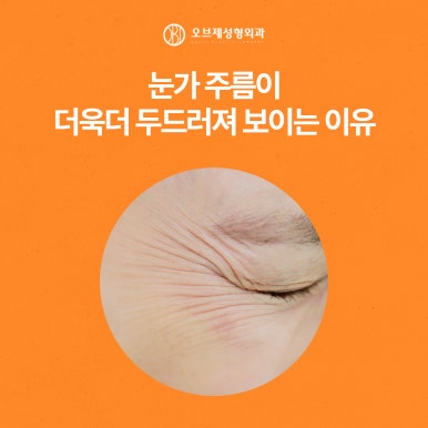 늘어지고 처지는 중년눈수술 관련 이미지 3