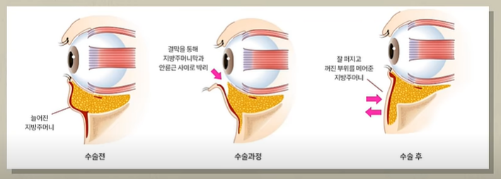 Midlife Lower Blepharoplasty for a Lively, Youthful Face #Director Kim Hyun-jo image 3