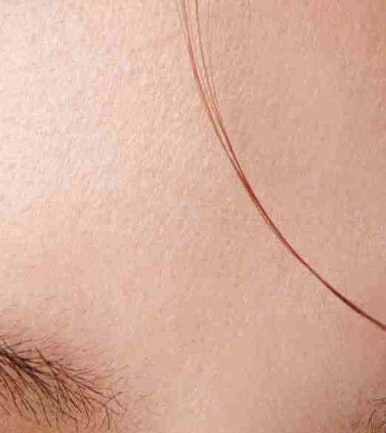 The Difference Between Upper Blepharoplasty and Incisional Double Eyelid Surgery #Director Kim Hyun-jo image 10