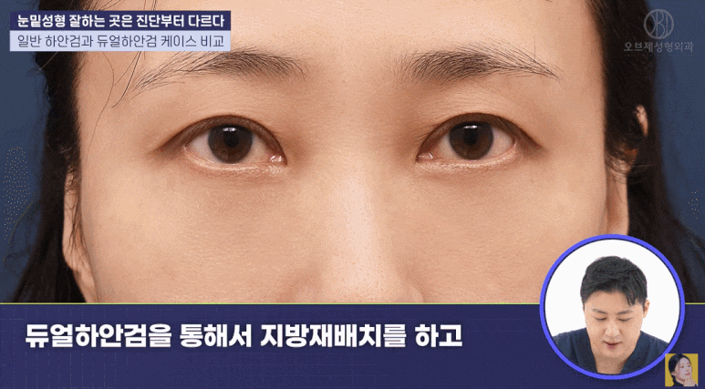 듀얼하안검, 눈밑지방재배치와 하안검을 동시에? 추천 대상과 회복 기간은? 관련 이미지 9