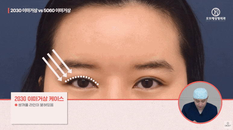 40대 이마거상과 20대 30대의 이마거상의 차이점 전격 비교! (성형외과 전문의 설명) 관련 이미지 6