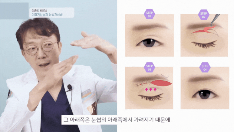 Forehead and Eyebrow Lift? A Selection Guide from Director Shin Jong-in image 7
