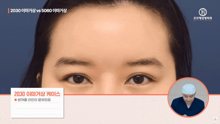 Forehead Lift in Your 20s: Why MZ Is Choosing It Instead of Double Eyelid Surgery image 8