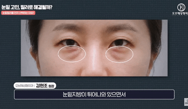 Why Does Satisfaction Differ Before and After Under-Eye Filler? image 5