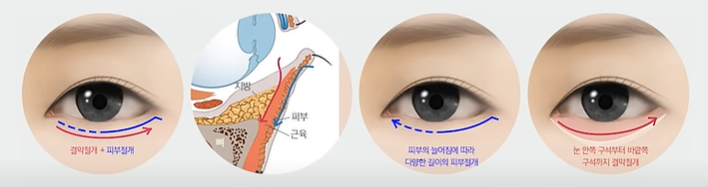 Midlife Lower Blepharoplasty for a Lively, Youthful Face #Director Kim Hyun-jo image 2