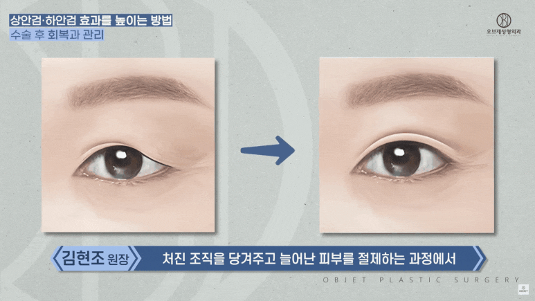 Upper Blepharoplasty Review: Worried You Won’t Be Able to Go to Work Because of Swelling? image 3