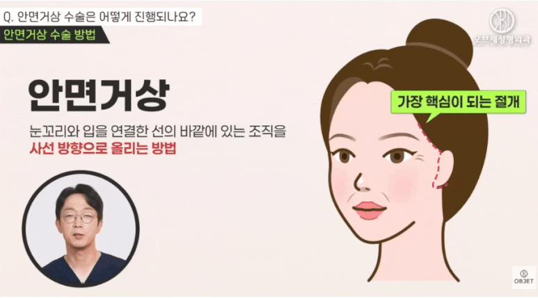 안면거상 전후, 자연스러움의 차이는 &lsquo;이것&rsquo;에서 결정됩니다 관련 이미지 3