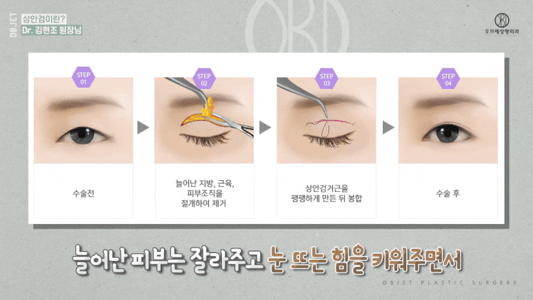 Eyelid Ptosis Surgery: Is Upper Blepharoplasty the Answer? <Dr. Kim Hyun-jo’s Response> image 9