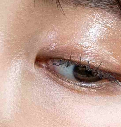 Brow Lift Procedure Method — Objet Plastic Surgery, Director Kim Hyun-jo image 14