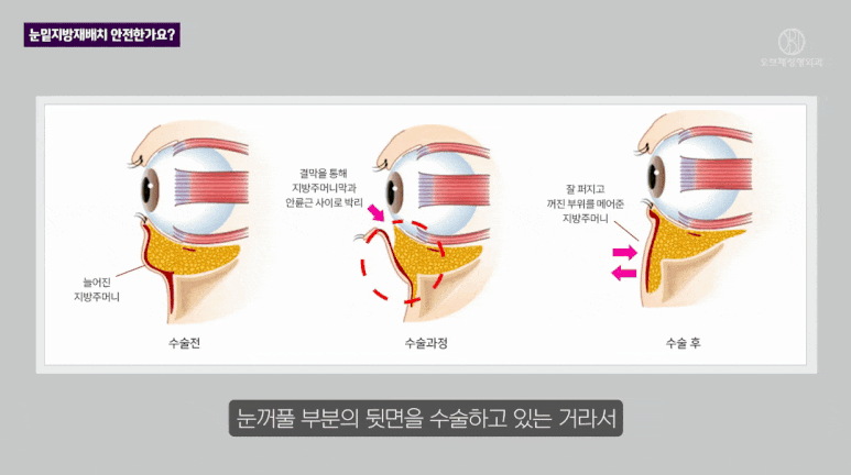 눈밑 지방재배치 수술, 가장 많이 들은 질문 TOP2는? 관련 이미지 9