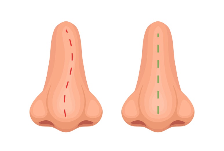 How to Resolve Nasal Congestion with Rhinoplasty, Obje Plastic Surgery image 3