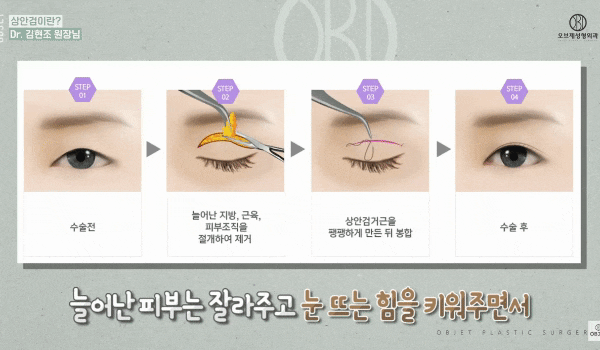 중년 상안검은 쌍꺼풀 무조건? 김현조 원장님의 오해 타파! 관련 이미지 3