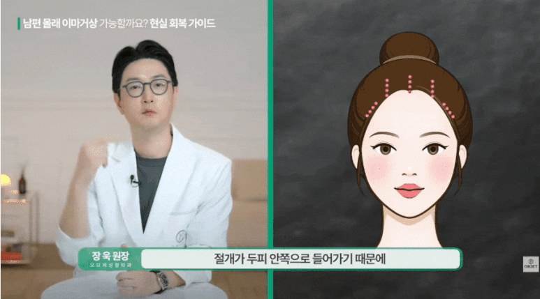 이마거상 붓기 숨기고 싶으세요? 장욱 원장님의 <TIP> 관련 이미지 3