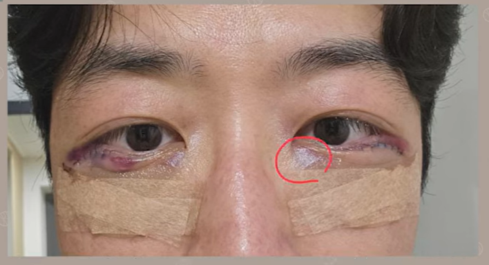듀얼하안검 후기, 수술당일부터 69일까지 생생보고 #오브제성형외과 장욱원장님 관련 이미지 6