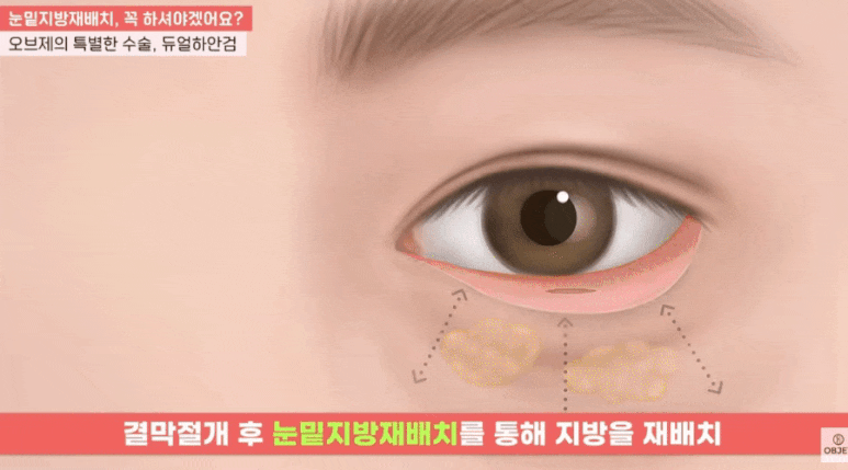 눈밑지 성형외과 유지 기간 평생 갈까? 김현조 원장님 정리 관련 이미지 12