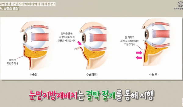 What’s the Difference Between Lower Blepharoplasty and Under-Eye Fat Repositioning? <MUST READ> If You’re Worried About Ectropion image 10