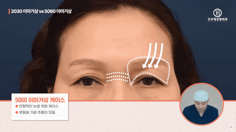 Forehead Lift in Your 20s: Why MZ Is Choosing It Instead of Double Eyelid Surgery image 10