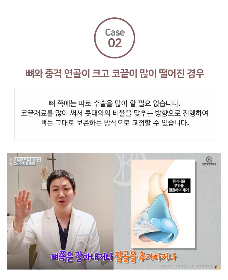 Causes of Hump Nose Rhinoplasty image 5