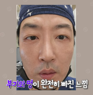 듀얼하안검 후기, 수술당일부터 69일까지 생생보고 #오브제성형외과 장욱원장님 관련 이미지 26