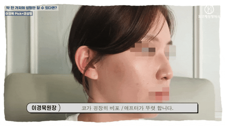 코성형 해야 하는 이유? 이경묵 원장님이 &lsquo;딱 하나&rsquo; 추천한다면 관련 이미지 11
