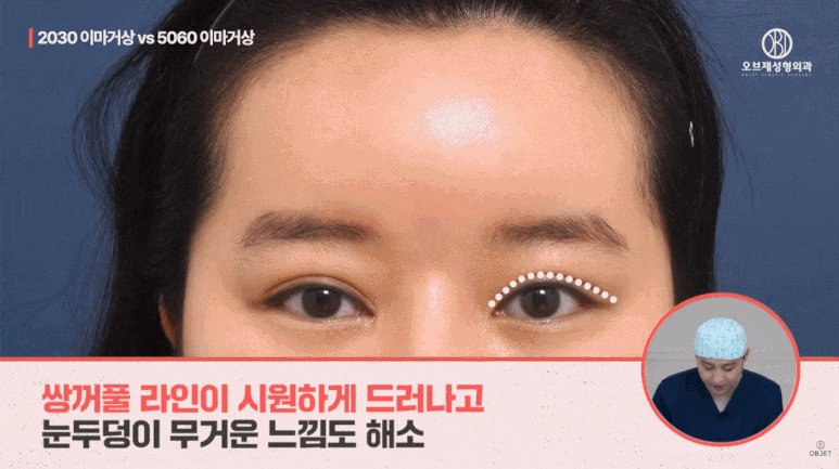 40대 이마거상과 20대 30대의 이마거상의 차이점 전격 비교! (성형외과 전문의 설명) 관련 이미지 7