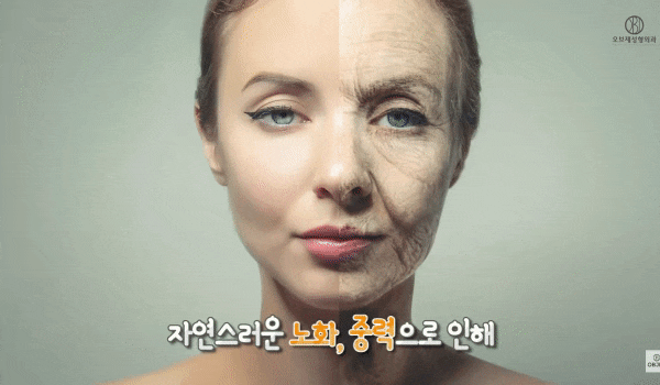 중년 상안검은 쌍꺼풀 무조건? 김현조 원장님의 오해 타파! 관련 이미지 2