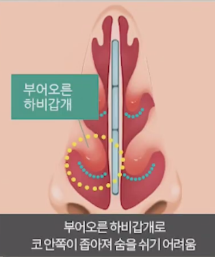 Nasal Surgery for Rhinitis: You Should Choose a Clinic That Knows ‘This’ Well! image 6