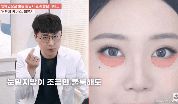 Can Lower-Eyelid Fat Repositioning Resolve Dark Circles? image 4