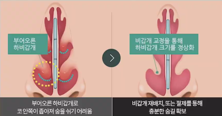 Nasal Surgery for Rhinitis: You Should Choose a Clinic That Knows ‘This’ Well! image 11