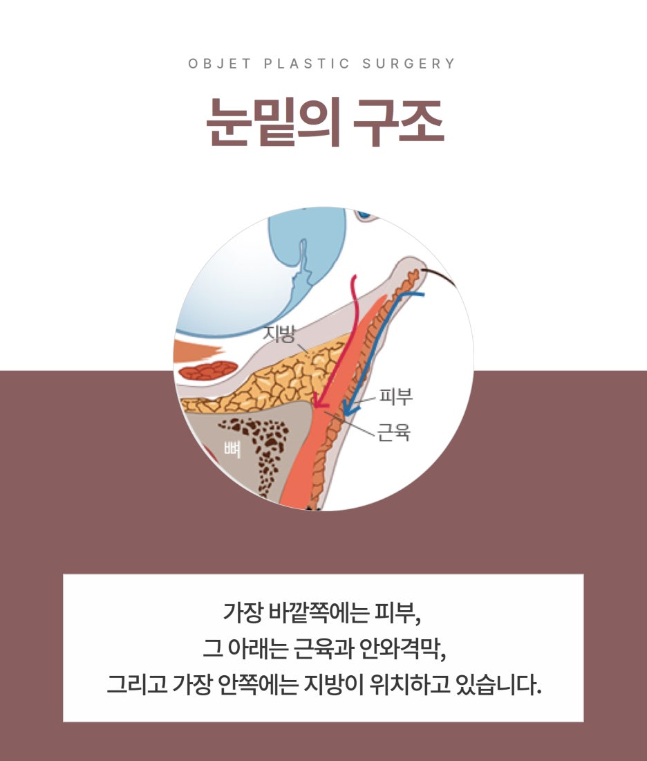 Gangnam Under-Eye Surgery: Which Procedure Is Right for Me? image 2