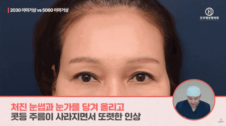 40대 이마거상과 20대 30대의 이마거상의 차이점 전격 비교! (성형외과 전문의 설명) 관련 이미지 12