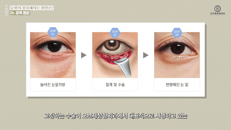 눈밑지방재배치 유지기간 성형외과 의사가 밝히는 2가지 진실! 관련 이미지 10