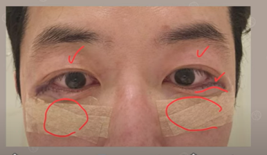 듀얼하안검 후기, 수술당일부터 69일까지 생생보고 #오브제성형외과 장욱원장님 관련 이미지 3