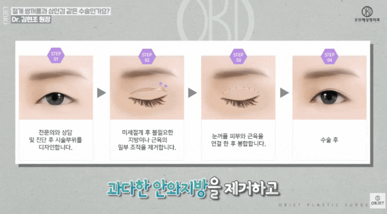 중년 눈수술? 쌍수? 김현조 원장님이 말하는 <차이점> 관련 이미지 3