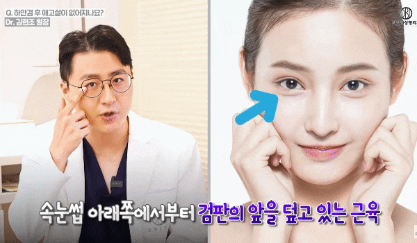 Lower Eyelid Surgery Methods: Clearing Up the <Misconception> That Under-Eye Smile Fullness Disappears! image 3