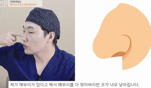 Is Osteotomy Essential for Hump Nose Surgery? Dr. Lee Kyung-mook Clears Up the Misunderstanding! image 4