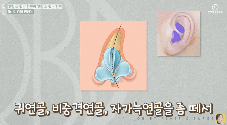 If You’re Looking for a Good Place for Crooked Nose Surgery, Read This First! Dr. Lee Kyung-mook Explains Which Crooked Noses Can Be Corrected image 8