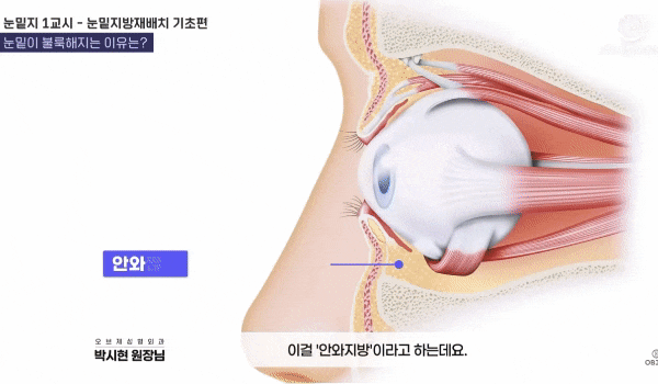 Under-Eye Fat Repositioning Before-and-After Results? Why Celebrities Choose It image 5